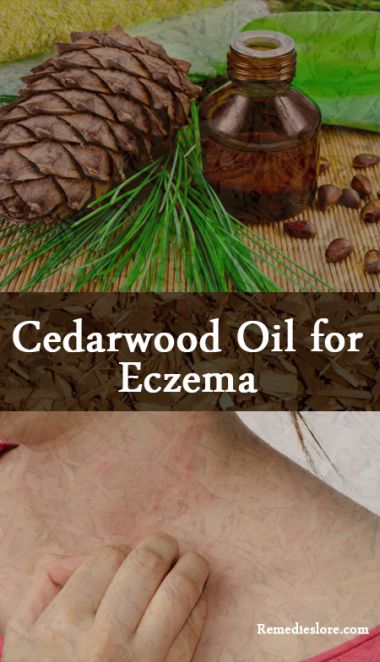 cedarwood-oil-for-eczema