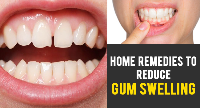 gum swelling reduce remedies lore