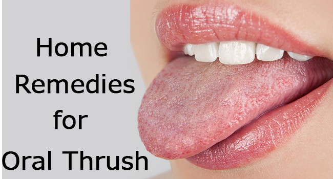 Home Remedies For Oral Thrush - Remedies Lore