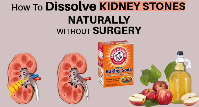 How To Dissolve Kidney Stones Naturally Without Surgery Remedies Lore   How To Dissolve Kidney Stones Naturally Without Surgery Fb 