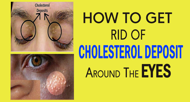 How To Get Rid Of Cholesterol Deposit Around The Eyes - Remedies Lore