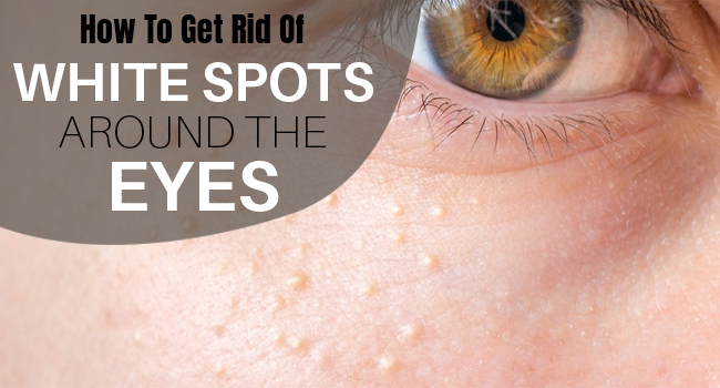 how-to-get-rid-of-those-white-spots-around-your-eyes