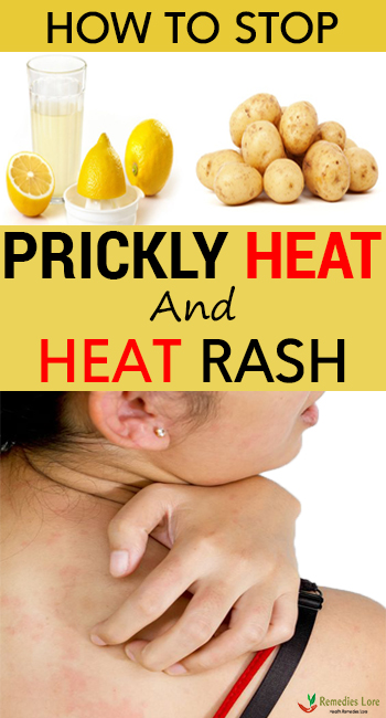 How To Stop Prickly Heat And Heat Rash Remedies Lore