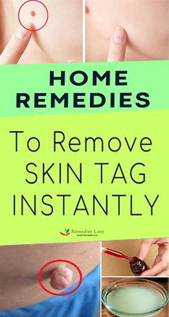 Top 10 Home Remedies To Remove Skin Tags Naturally Remedies Lore