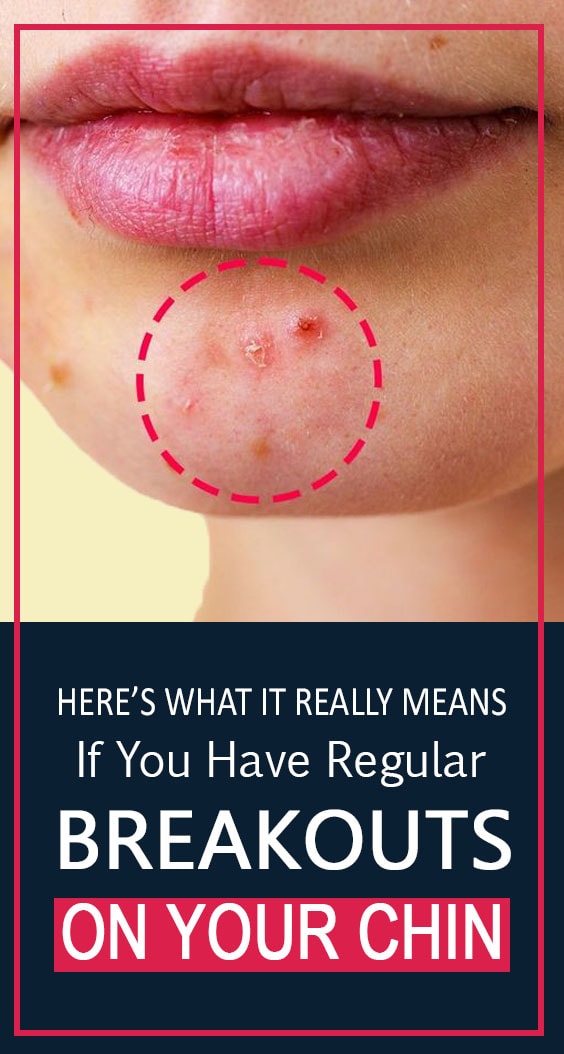 Do You Have Regular Breakouts On Your Chin Here s What It Really Means 