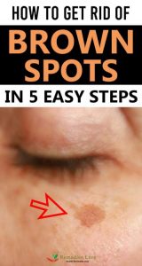 How to Get Rid Of Brown Spots in 5 Easy Steps - Remedies Lore