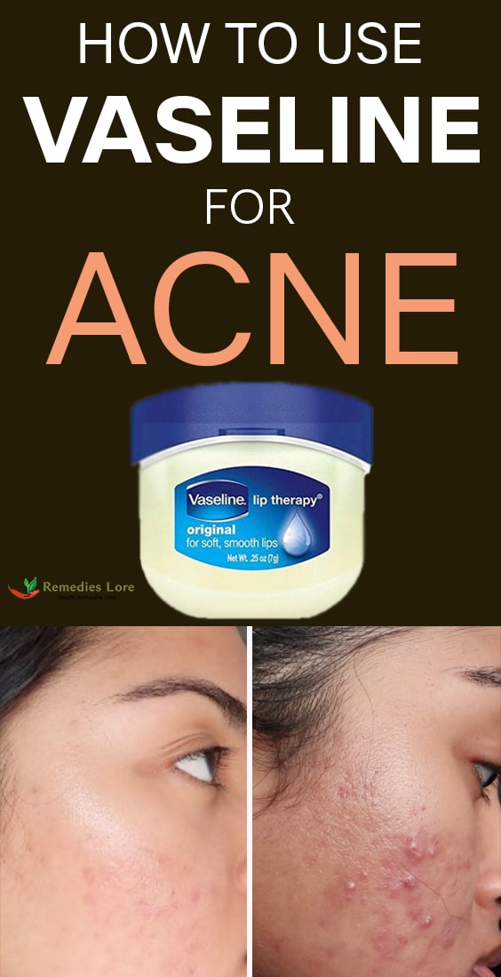 How to Use Vaseline for Acne Remedies Lore