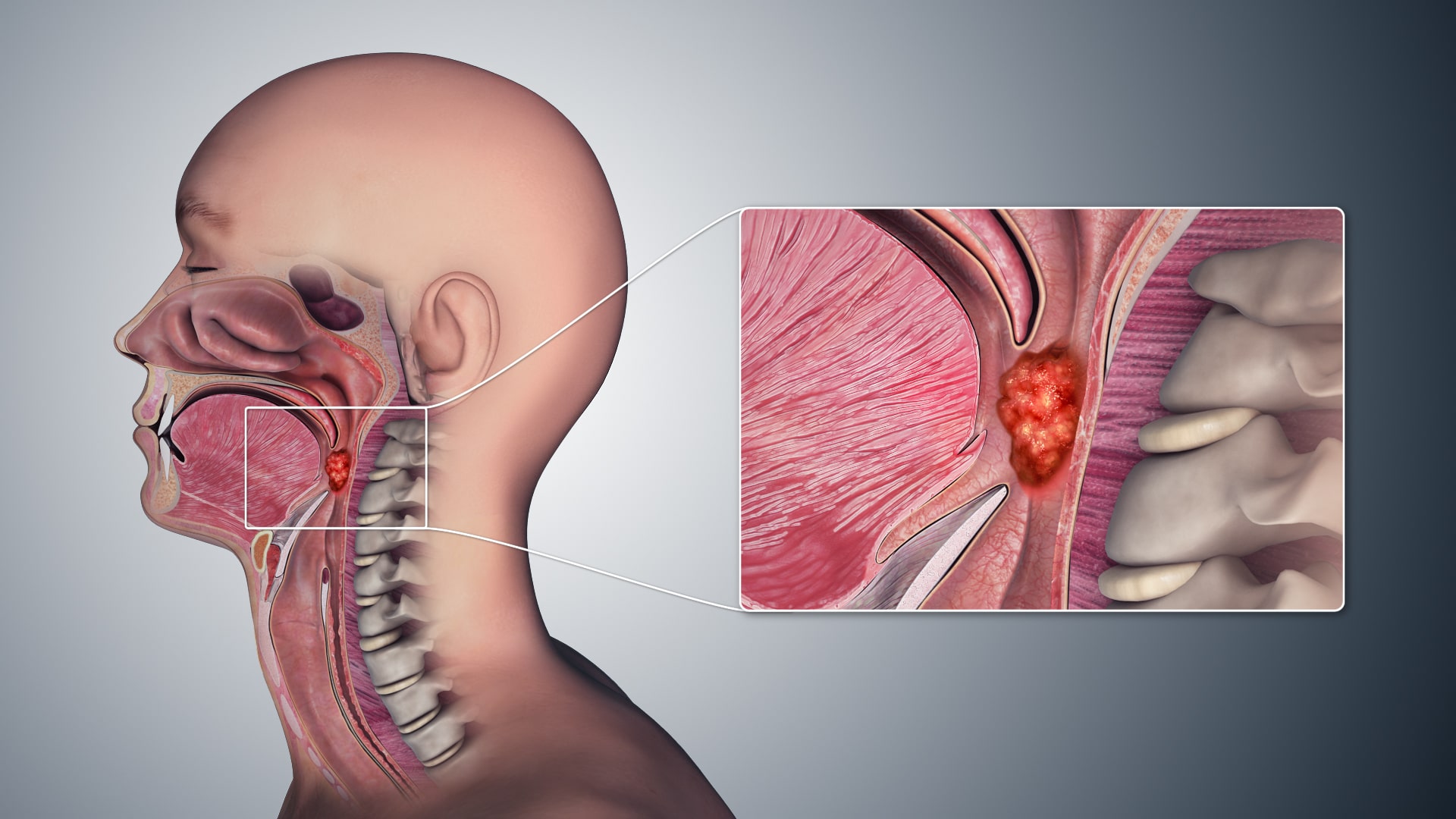 Throat Cancer Early Signs Symptoms Causes And Prognosis Remedies Lore 2057