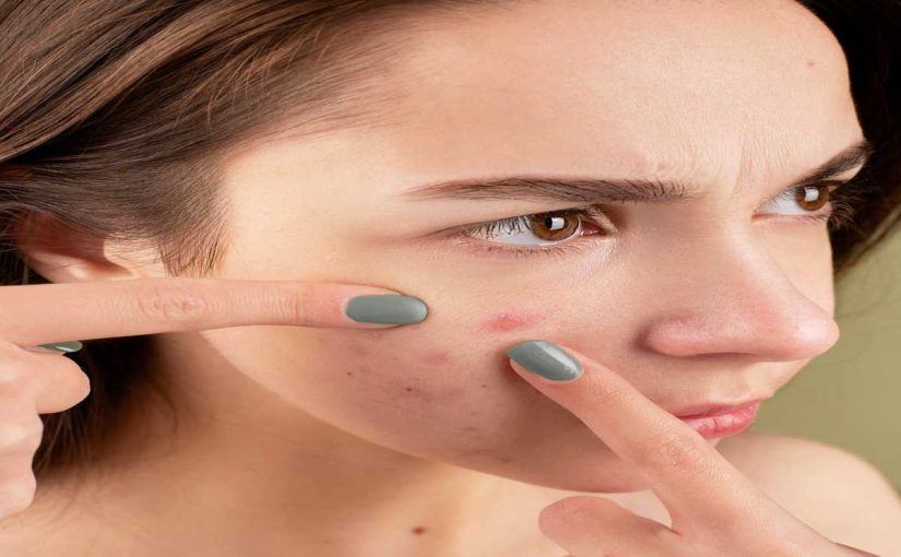 Home Remedies for Acne: Natural Solutions for Clear Skin